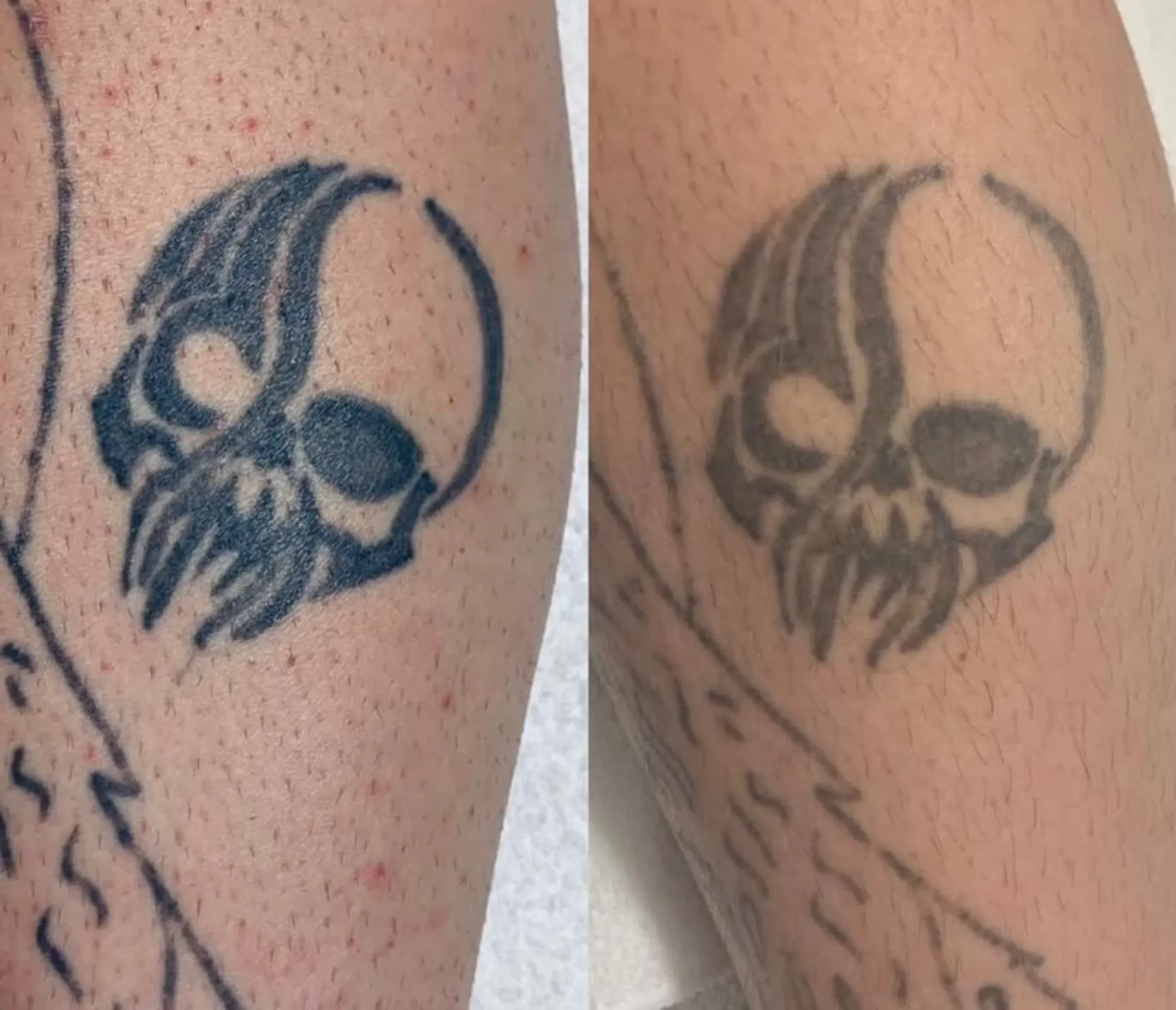 Speed Up Tattoo Removal After Laser: Tips for Faster Results