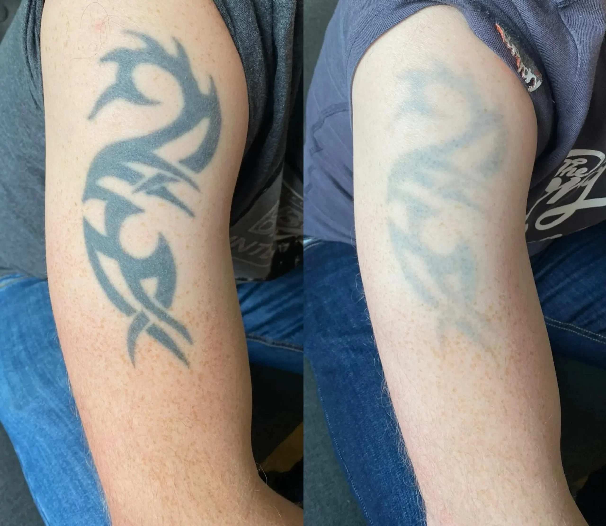 affordable tattoo removal melbourne