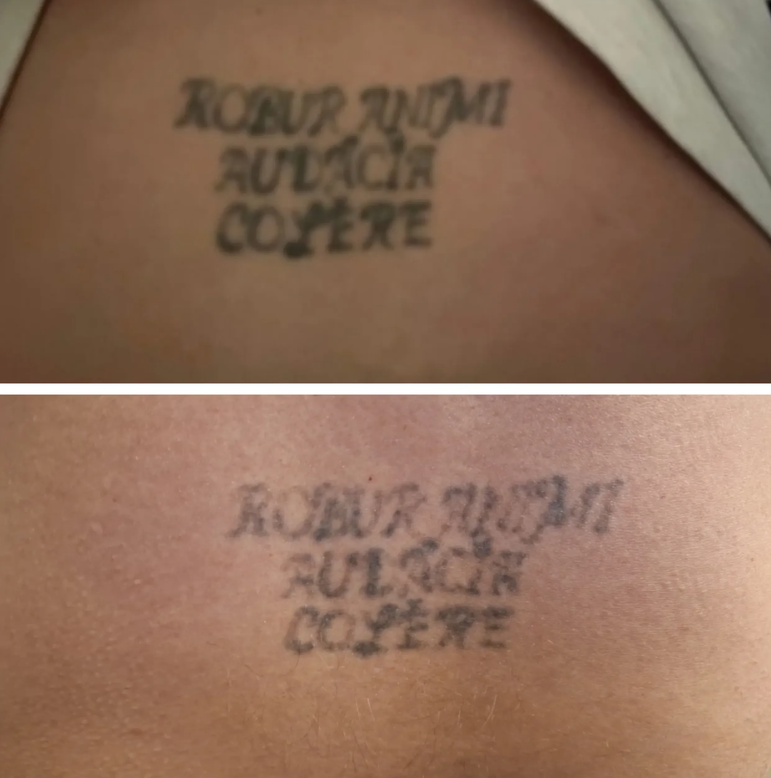 how much is tattoo laser removal