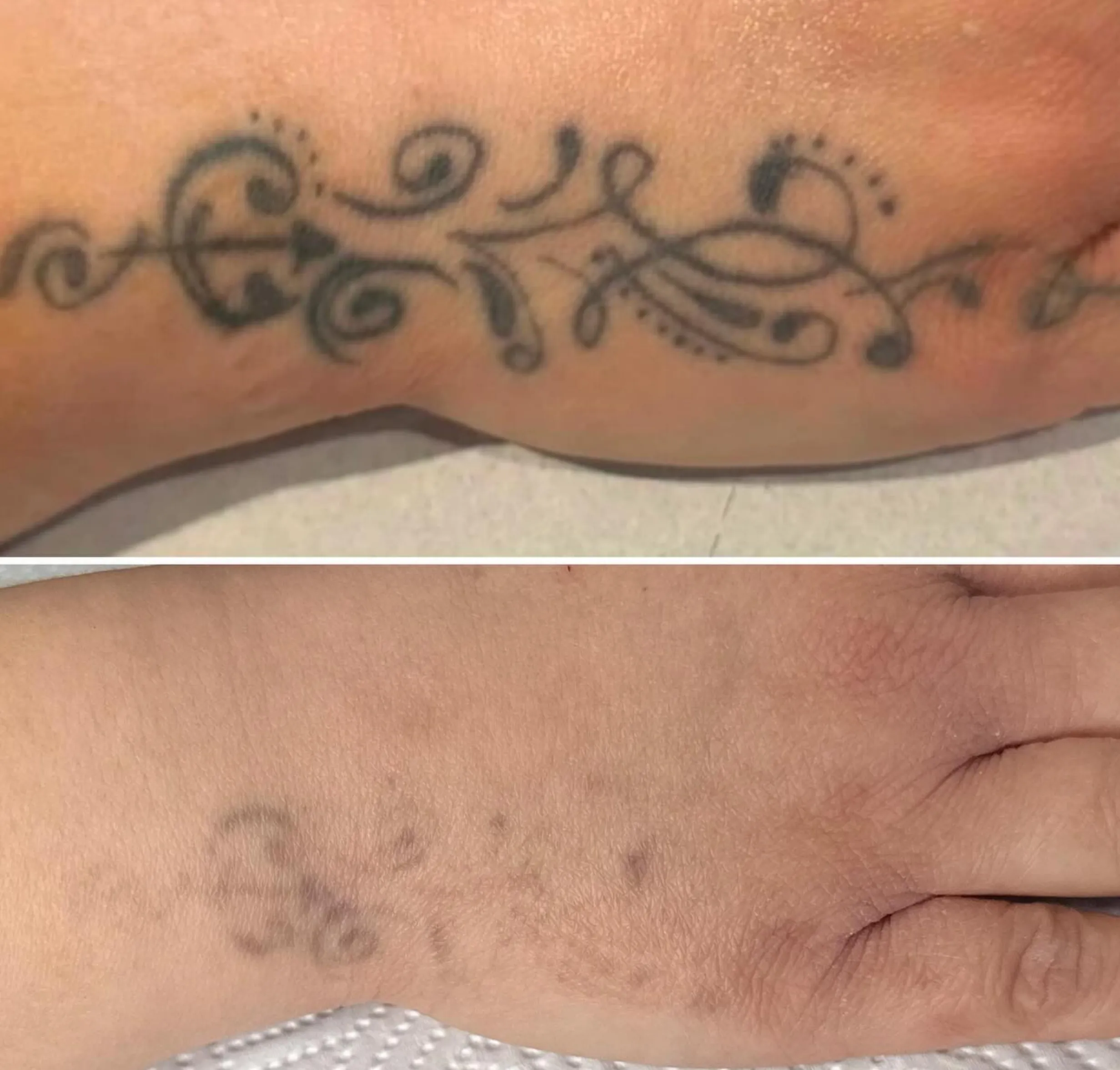 laser clinic tattoo removal