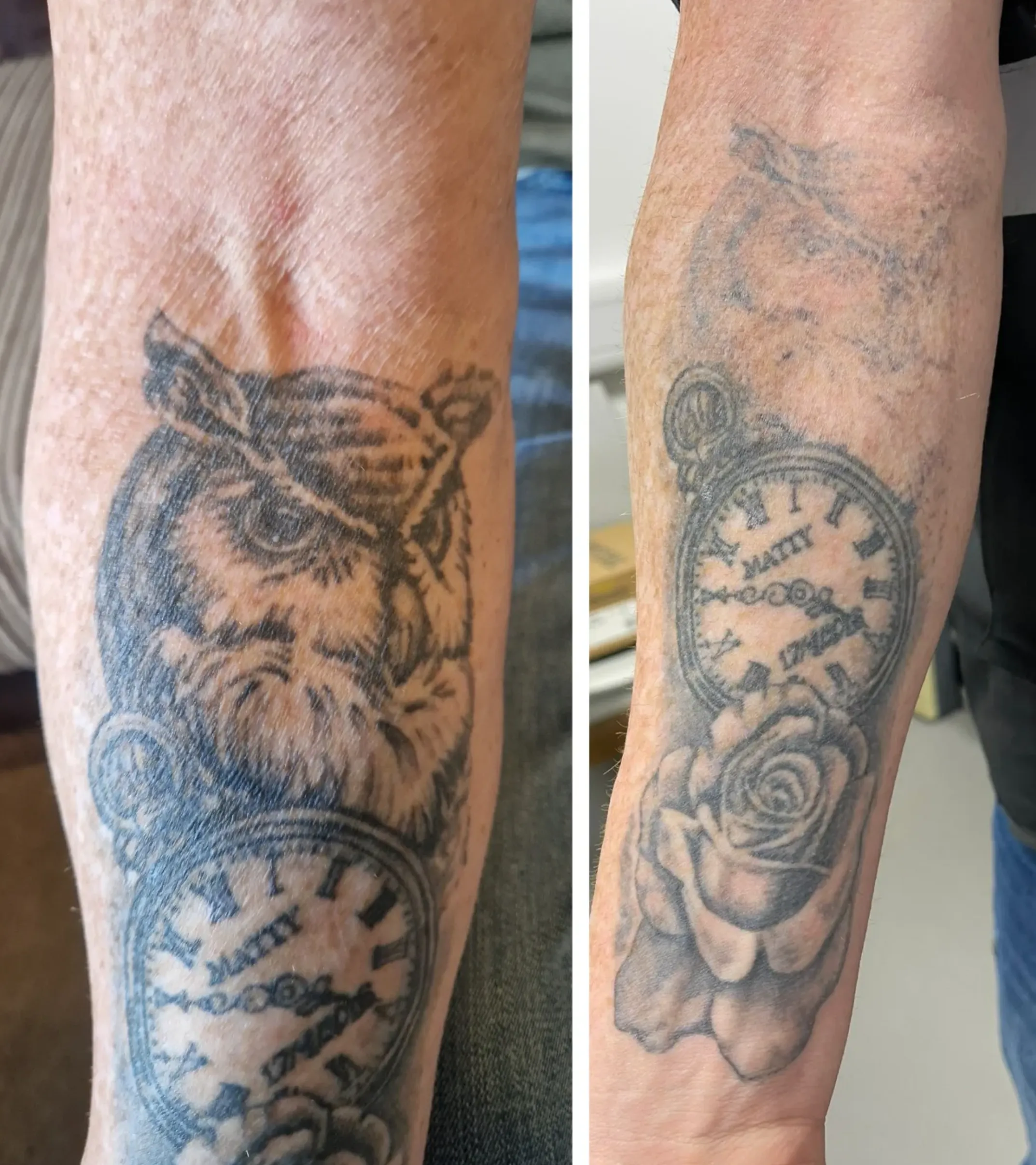 tattoo removal laser melbourne