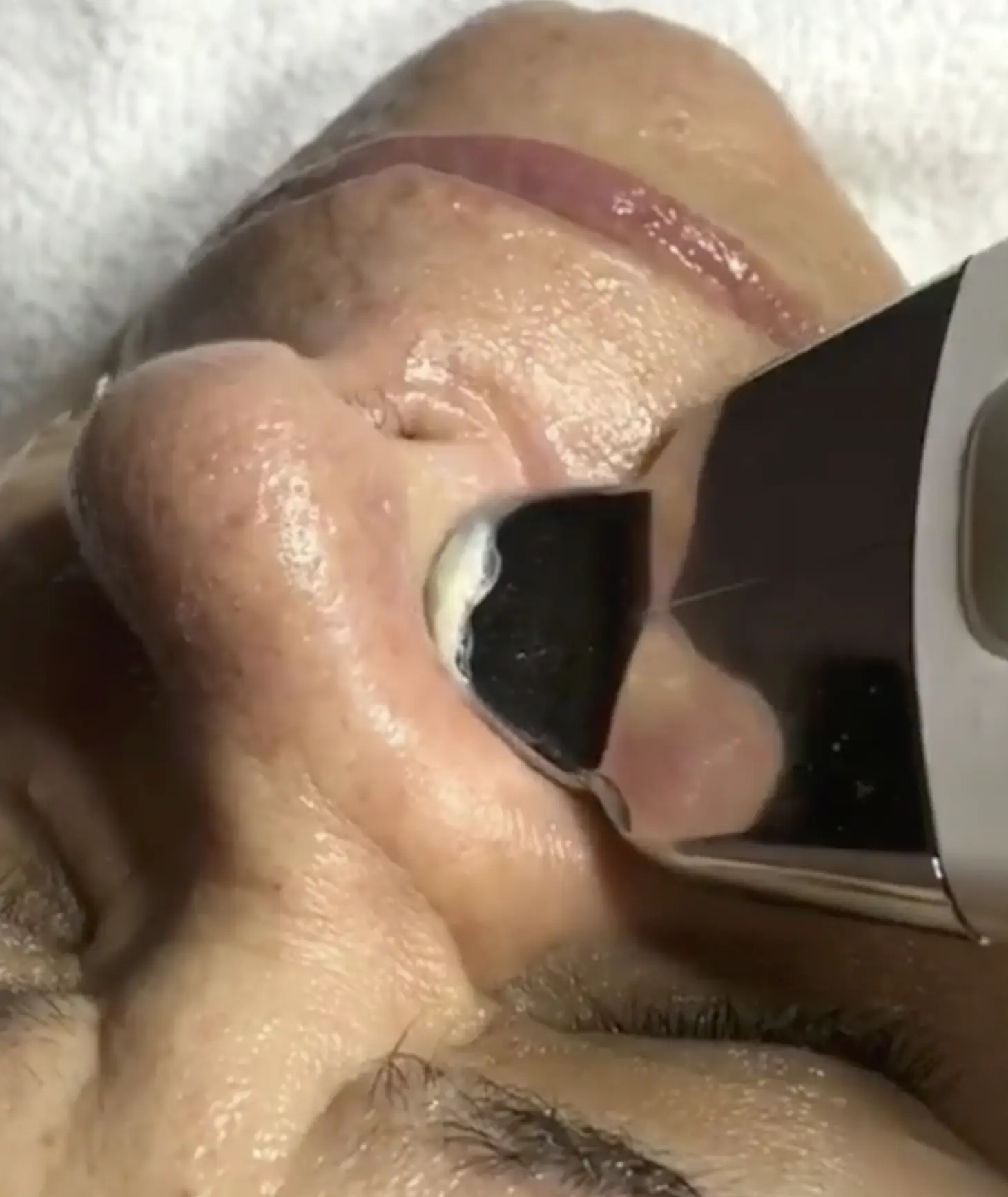vampire facial brisbane